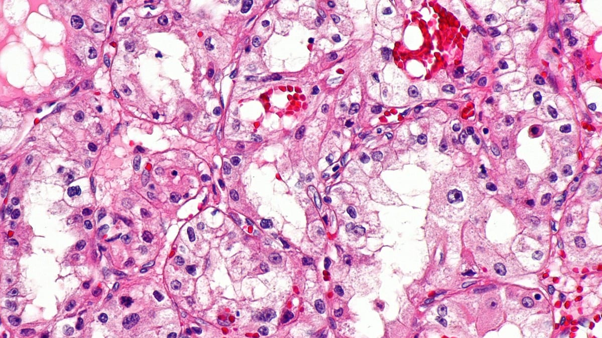 Tejido tumoral teñido observado con un microscopio