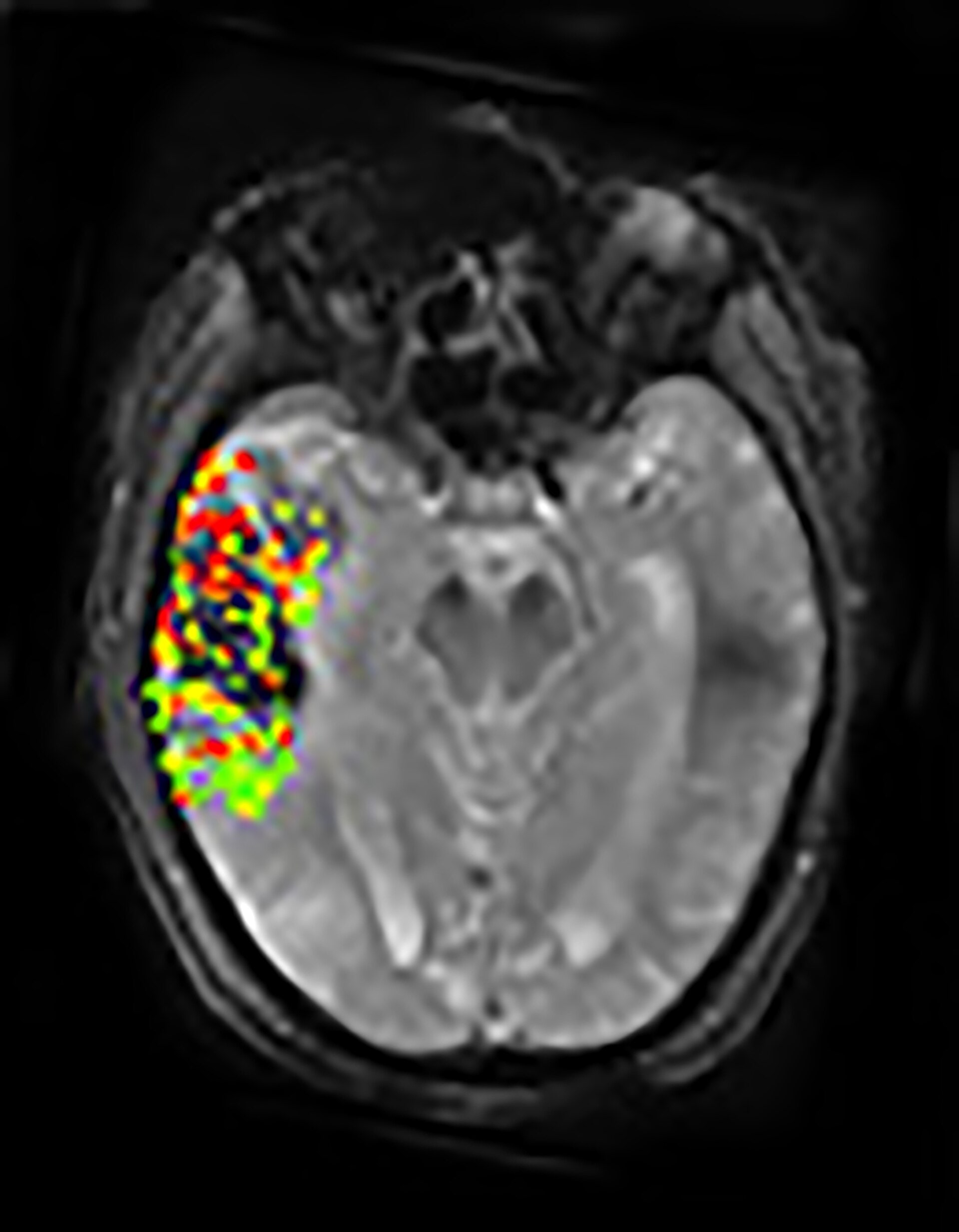 Imagen médica del cerebro utilizada para evaluar un ACV